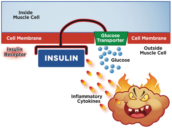 Insulin resistance: inflammation (in this case from enlarged fat cells) in diabetes short-circuits the insulin receptor, preventing glucose from entering the muscle cell.